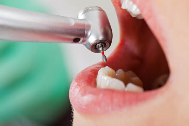 Best Knocked-Out Tooth (Avulsed Tooth) Treatment in Collingdale, PA